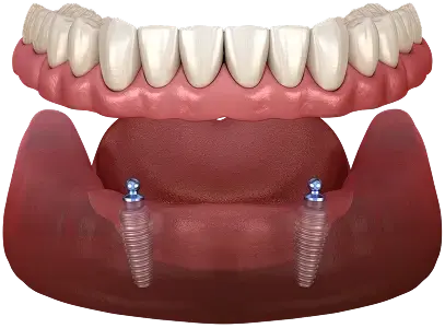 Implant-supported dentures with two dental implants anchoring a full upper denture in Sugar Land.