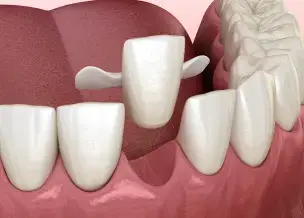 Maryland bridge dental restoration showing missing tooth replacement with adjacent tooth support.