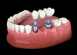 Implant-supported dental bridge illustration showing two dental implants with connecting bridge restoring missing teeth.