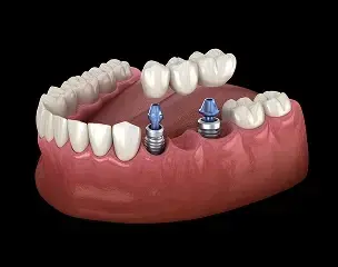 Dental implant bridge illustration showing two implants supporting a row of replacement teeth on a model jawbone.