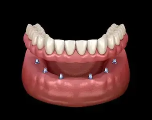 Implant-supported denture illustration showing dental implants anchoring a full upper denture in Sugar Land.