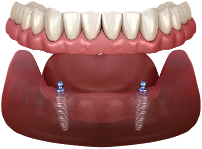 Implant Supported Dentures