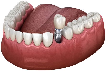Single Dental Implant Special