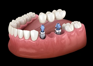 Implant-supported dental bridge restoring multiple missing teeth.
