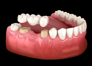 Traditional dental bridge replacing a missing tooth.