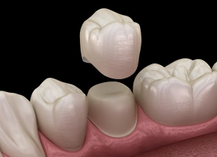 Porcelain dental crown matching the natural appearance of a tooth.