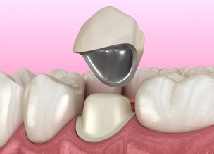 Porcelain-fused-to-metal dental crown for durable tooth restoration.