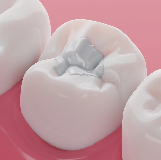 Dentist placing a tooth-colored dental filling to restore a cavity.