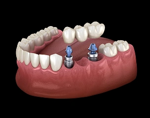 Implant-supported bridge replacing multiple missing teeth.