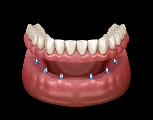 Implant-supported dentures providing a secure, stable smile.