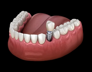 Single tooth dental implant replacing one missing tooth.