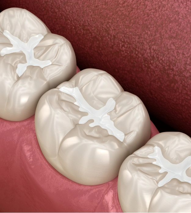 Close up of dental sealants on teeth