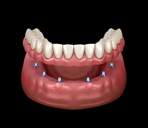 Implant-supported dentures for a secure, comfortable