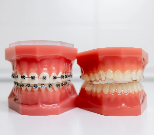 Braces used to straighten teeth